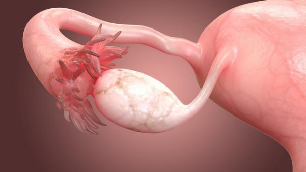 Tiến triển và biến chứng của u buồng trứng