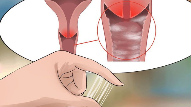 Nhiễm khuẩn âm đạo-Người phụ nữ nào cũng có thể mắc Cách xác định nhiễm khuẩn âm đạo | Vinmec