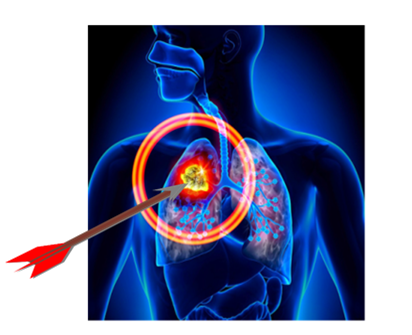 Liệu pháp trúng đích sử dụng trong điều trị ung thư