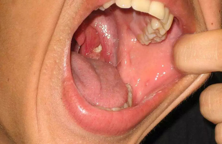 Dấu hiệu nhận biết và cách phòng tránh ung thư Amidan khẩu cái