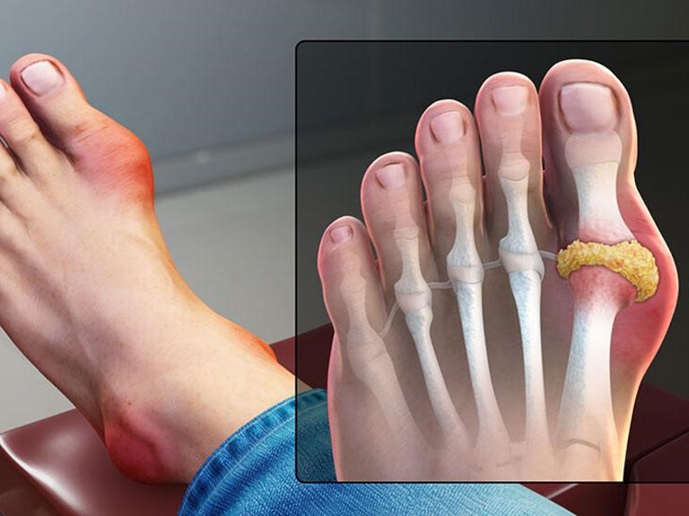 Bệnh gút (gout) là gì? Triệu chứng, chẩn đoán và cách điều trị