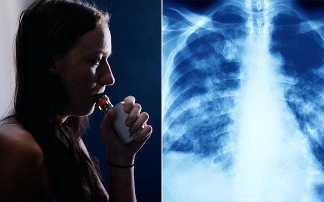 Thuốc lá điện tử gây tổn thương phổi và những tác hại khác cực kì nguy hiểm