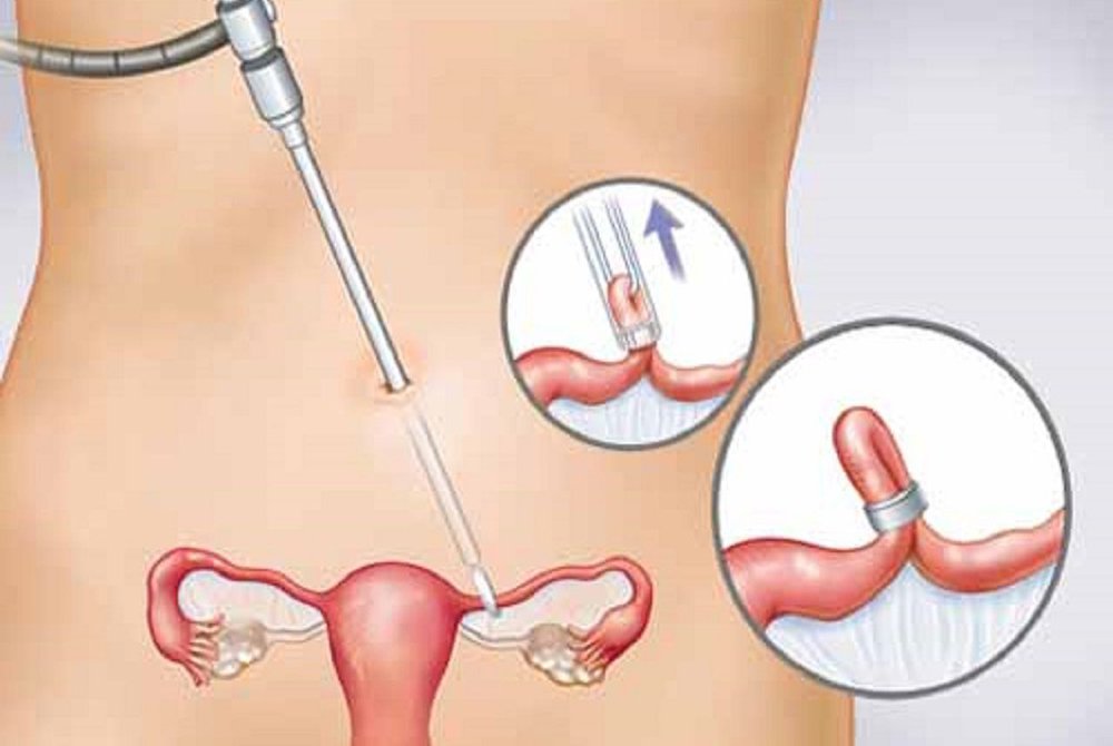 Triệt sản nữ bằng thắt và cắt vòi tử cung là gì? Triệt sản nữ bằng thắt và cắt vòi tử cung là gì?