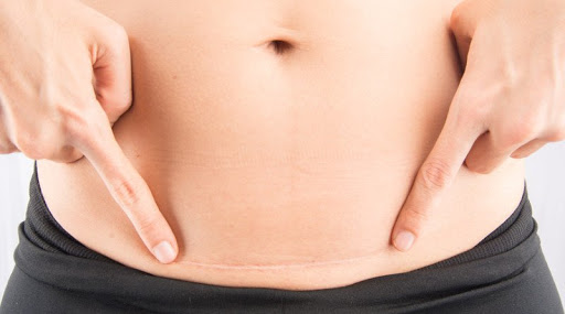 Tụ dịch sẹo vết mổ tử cung: Những điều cần biết Tụ dịch sẹo vết mổ tử cung: Những điều cần biết