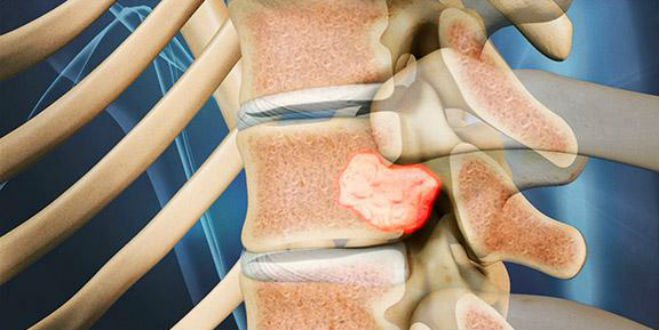 Triệu chứng và cách điều trị u tủy sống hiệu quả Triệu chứng và cách điều trị u tủy sống hiệu quả