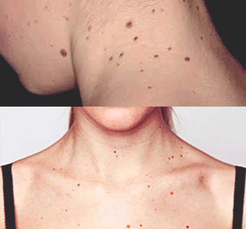 Tìm hiểu về căn bệnh ung thư đầu cổ: Nguyên nhân, biểu hiện, cách chữa trị