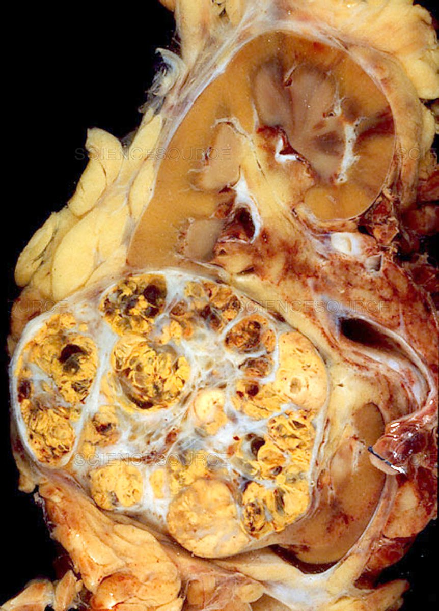 Triệu chứng và cách phòng tránh ung thư thận hiệu quả