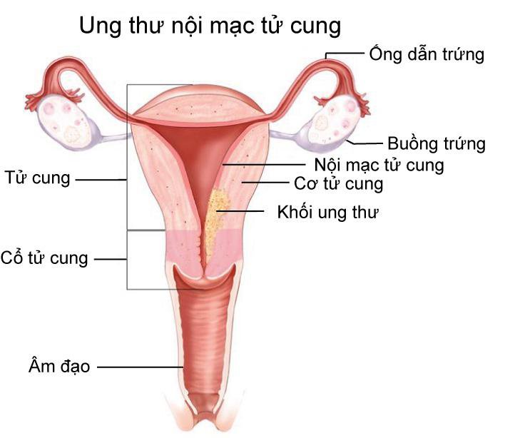 Triệu chứng và cách phòng tránh ưng thư nội mạc tử cung Triệu chứng và cách phòng tránh ưng thư nội mạc tử cung