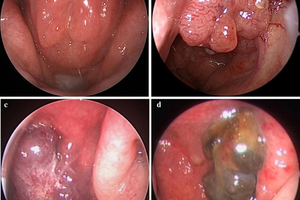 Phương pháp điều trị ung thư vòm họng giai đoạn đầu