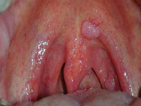 Review] Các dấu hiệu giúp bạn nhận biết ung thư vòm họng