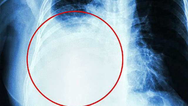 Những vị trí ung thư vú có thể di căn đến mà bạn phải biết Những vị trí ung thư vú có thể di căn đến mà bạn phải biết