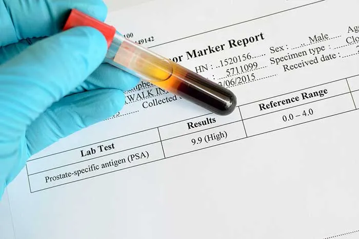 Quy trình và cách thực hiện khi dùng chất chỉ điểm ung thư