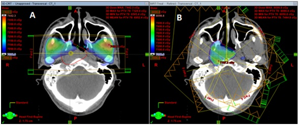 Ưu - Nhược điểm của phương pháp xạ trị điều biến liều (IMRT) Ưu - Nhược điểm của phương pháp xạ trị điều biến liều (IMRT)