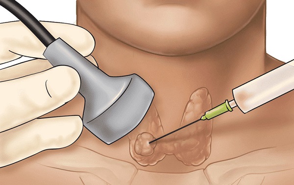 Phương pháp xét nghiệm ung thư vòm họng phổ biến