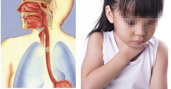 Cách xử lí an toàn khi dị vật mắc kẹt ở đường thở của trẻ em Cách xử lí an toàn khi dị vật mắc kẹt ở đường thở của trẻ em