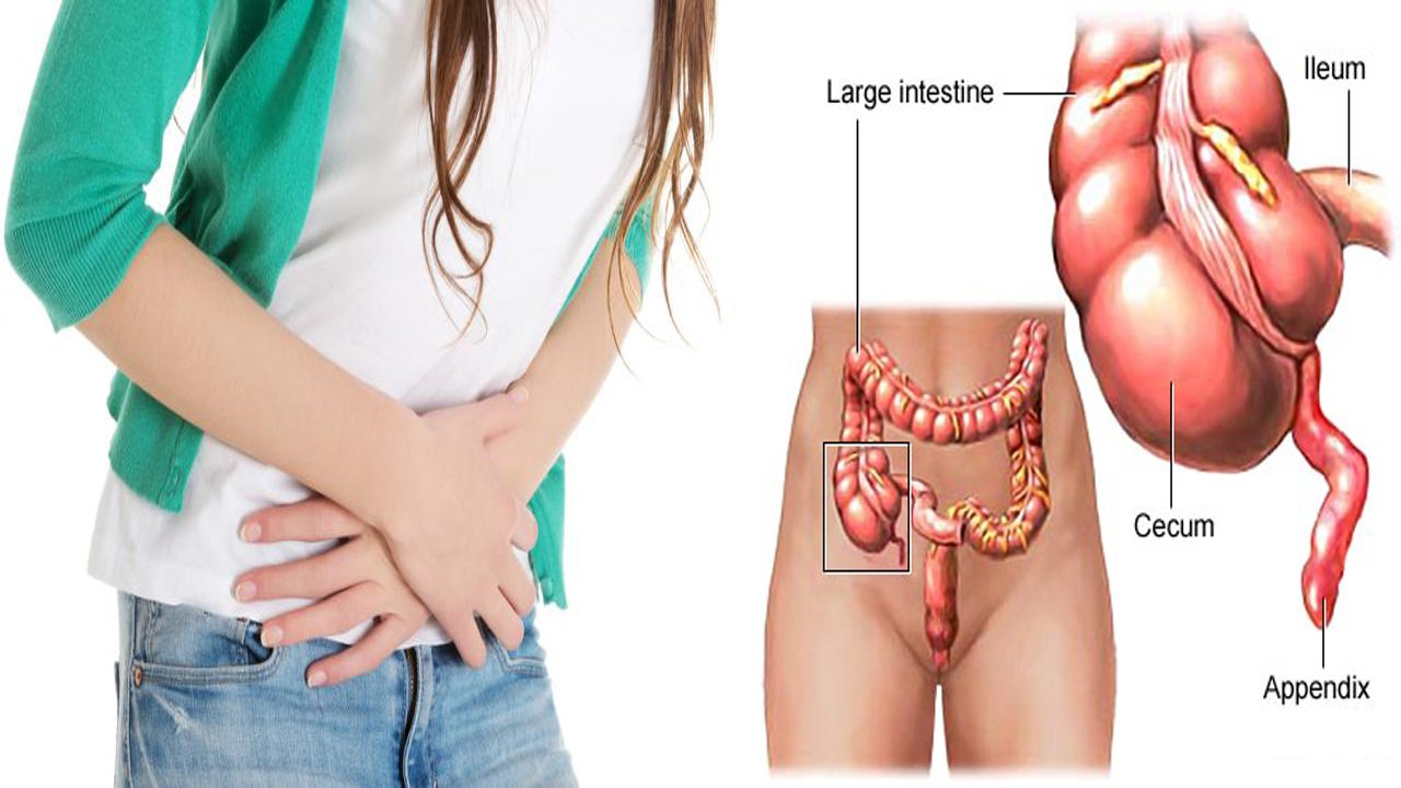Xử trí viêm phúc mạc sau phẫu thuật sản khoa Xử trí viêm phúc mạc sau phẫu thuật sản khoa